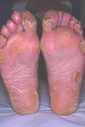 Unguento di eczema marrone