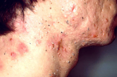 Cystic Acne Chest Image picture photo acne