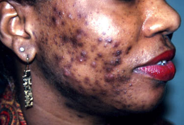 cause of acne vulgaris