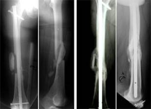 Fratture i fattori che influenzano il consolidamento delle ...